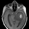 5A2 Astrocytoma, pilocytic (Case 5) T1 FL2D 1 - Copy