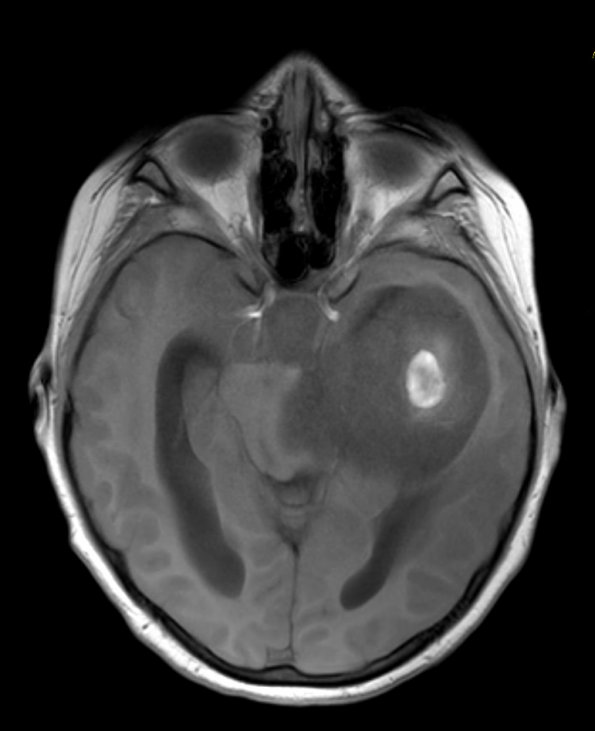 5A2 Astrocytoma, pilocytic (Case 5) T1 FL2D 1 - Copy