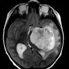 5A3 Astrocytoma, pilocytic (Case 5) T2 - Copy