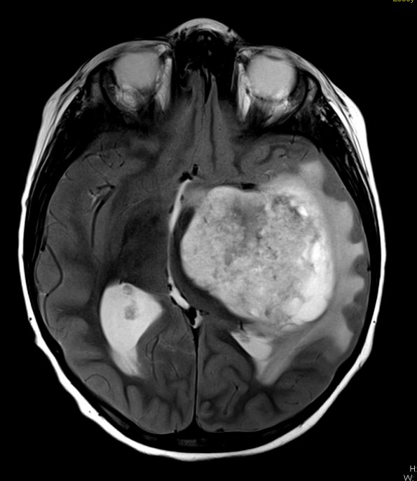 5A3 Astrocytoma, pilocytic (Case 5) T2 - Copy