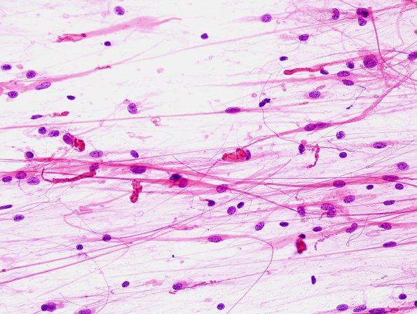 5B1 Astrocytoma, pilocytic (Case 5) H&E 2