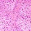 5B2 Astrocytoma, pilocytic (Case 5) H&E 9