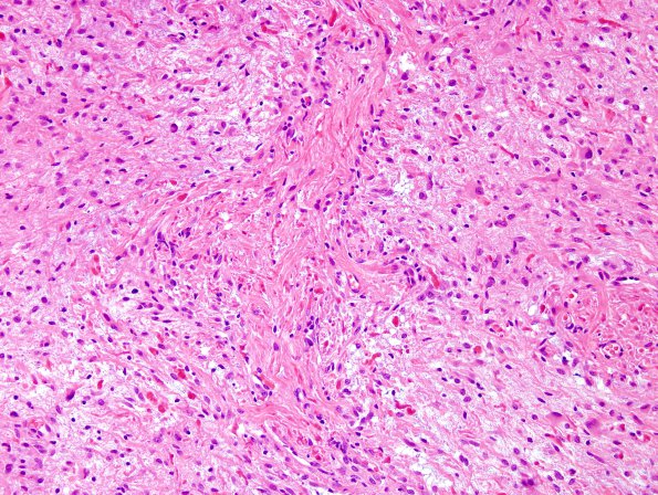 5B2 Astrocytoma, pilocytic (Case 5) H&E 9