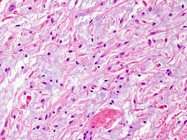 5B3 Astrocytoma, pilocytic (Case 5) H&E 11