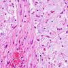 5B4 Astrocytoma, pilocytic (Case 5) H&E 5