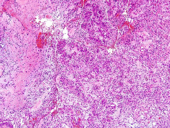 5B5 Astrocytoma, pilocytic (Case 5) H&E 10