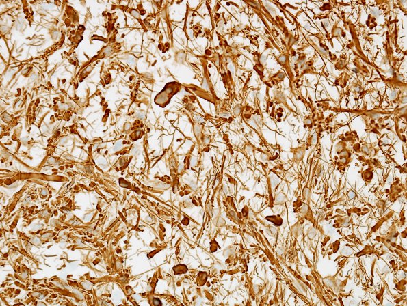 5C1 Astrocytoma, pilocytic (Case 5) GFAP 1