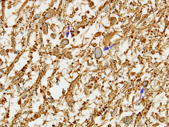 5C2 Astrocytoma, pilocytic (Case 5) GFAP 3 copy