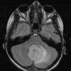 7A1 Astrocytoma, pilocytic (necrosis, Case 7) FLAIR