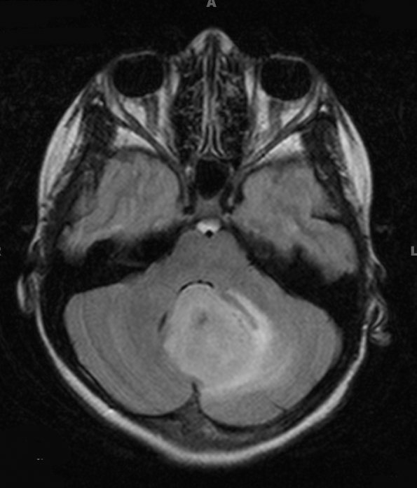 7A1 Astrocytoma, pilocytic (necrosis, Case 7) FLAIR