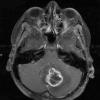 7A2 Astrocytoma, pilocytic (necrosis, Case 7) T1 W 3