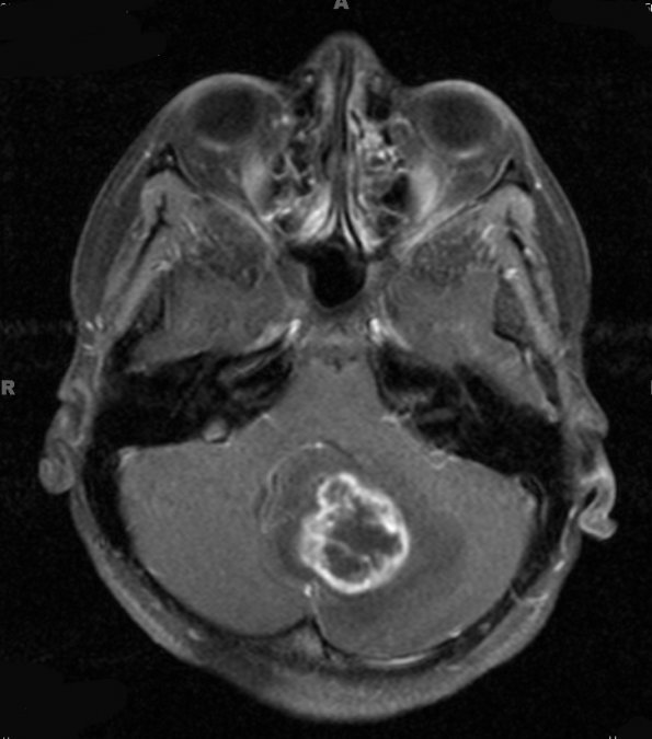 7A2 Astrocytoma, pilocytic (necrosis, Case 7) T1 W 3