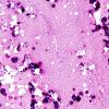 7B1 Astrocytoma, pilocytic (Case 7) H&E 2