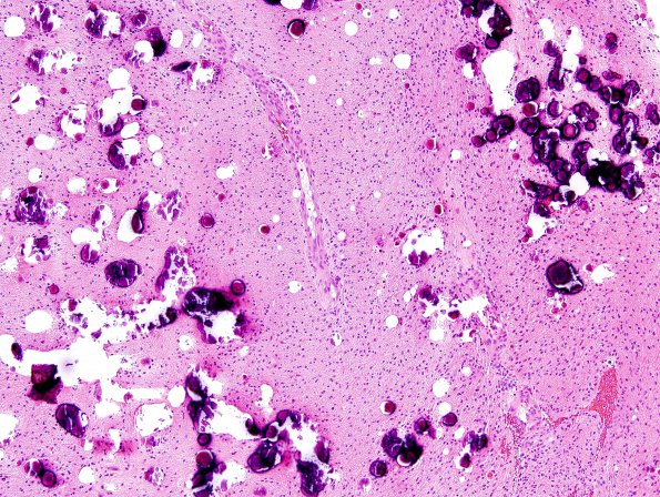 7B1 Astrocytoma, pilocytic (Case 7) H&E 2