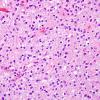 7B2 Astrocytoma, pilocytic (Case 7) H&E 15.