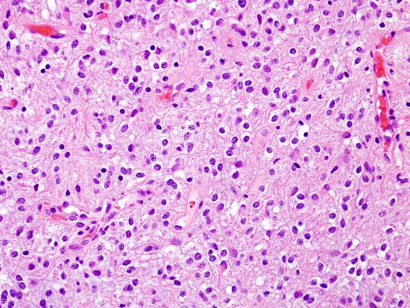 7B2 Astrocytoma, pilocytic (Case 7) H&E 15.