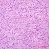 7B3 Astrocytoma, pilocytic (Case 7) H&E 1.