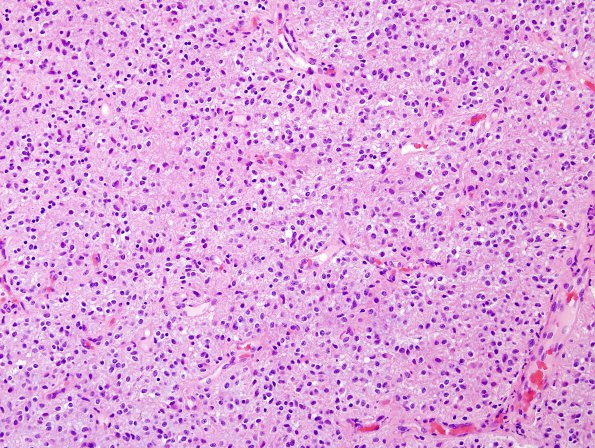 7B3 Astrocytoma, pilocytic (Case 7) H&E 1.