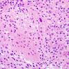 7B4 Astrocytoma, pilocytic (Case 7) H&E 6