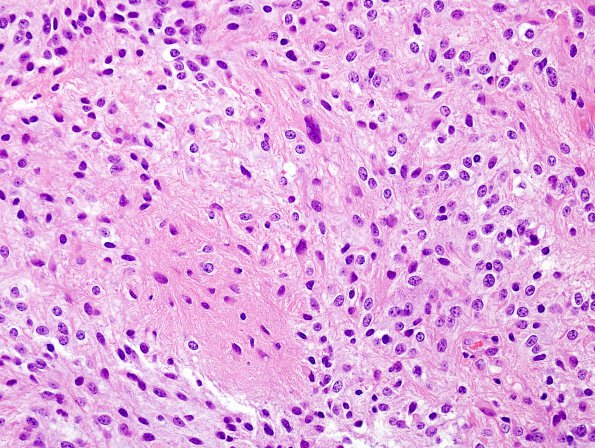 7B4 Astrocytoma, pilocytic (Case 7) H&E 6