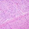 7B6 Astrocytoma, pilocytic (Case 7) H&E 