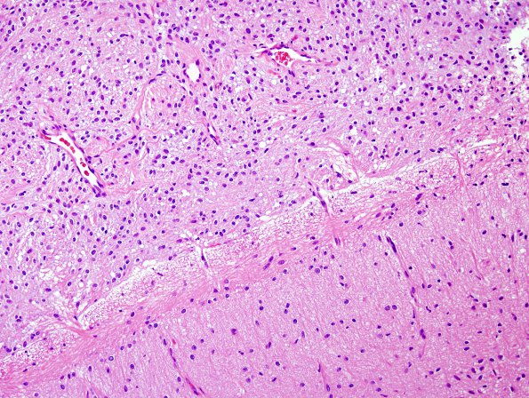 7B6 Astrocytoma, pilocytic (Case 7) H&E 