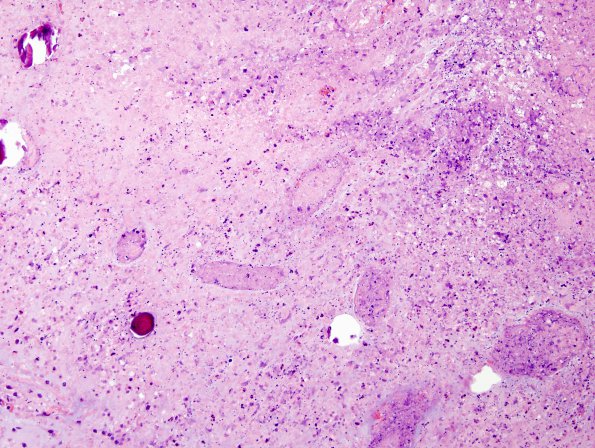 7B7 Astrocytoma, pilocytic (necrosis, Case 7) H&E 5