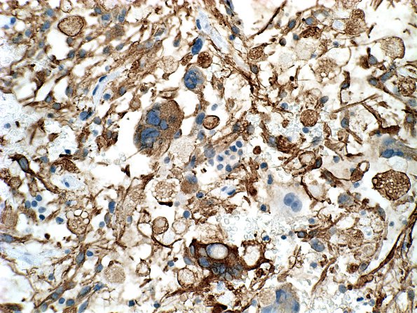 8B Astrocytoma, pilocytic  EGBs (Case 8) GFAP