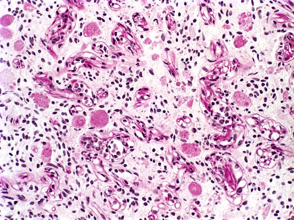 8C1 Astrocytoma, pilocytic  EGBs (Case 8) PAS