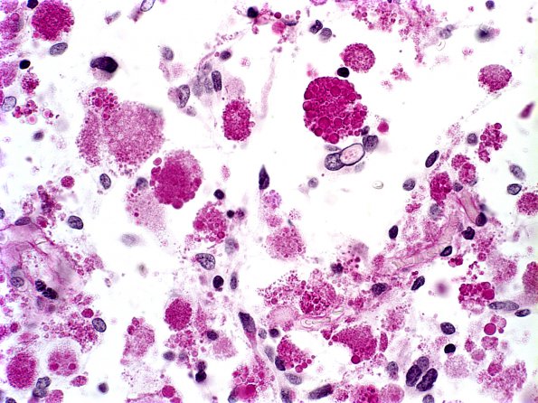 8C2 Astrocytoma, pilocytic  EGBs (Case 8) PAS b