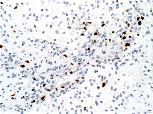 8D Astrocytoma, pilocytic  EGBs (Case 8) Mib vessel