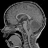 9A1 Astrocytoma, pilocytic (Case 9) T1 - Copy