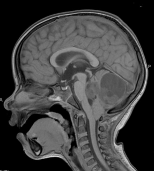 9A1 Astrocytoma, pilocytic (Case 9) T1 - Copy