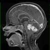 9A2 Astrocytoma, pilocytic (Case 9) T1 W a - Copy