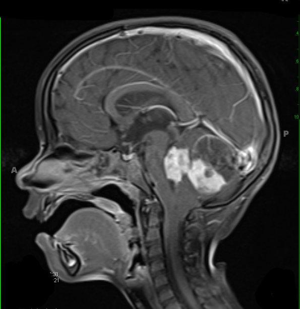 9A2 Astrocytoma, pilocytic (Case 9) T1 W a - Copy