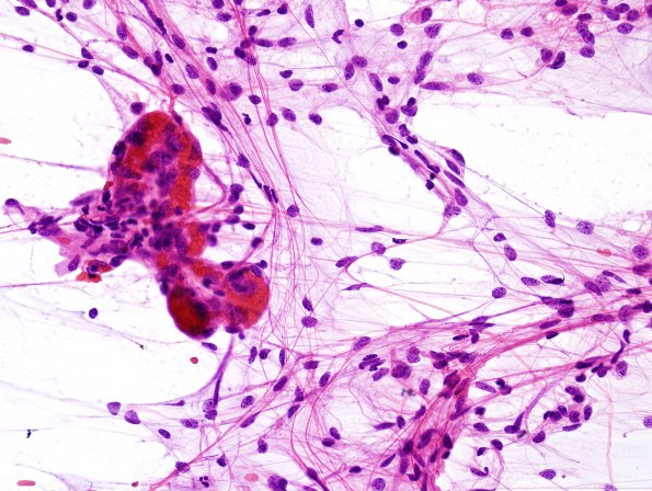 9B1 Astrocytoma, pilocytic (Case 9) smear 3.