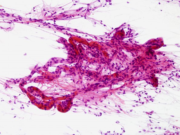 9B2 Astrocytoma, pilocytic (Case 9) smear 5