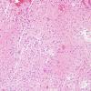 9C1 Astrocytoma, pilocytic (Case 9) H&E 2