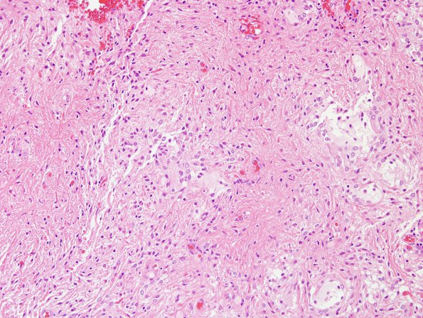 9C1 Astrocytoma, pilocytic (Case 9) H&E 2