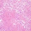 9C2 Astrocytoma, pilocytic (Case 9) H&E 3