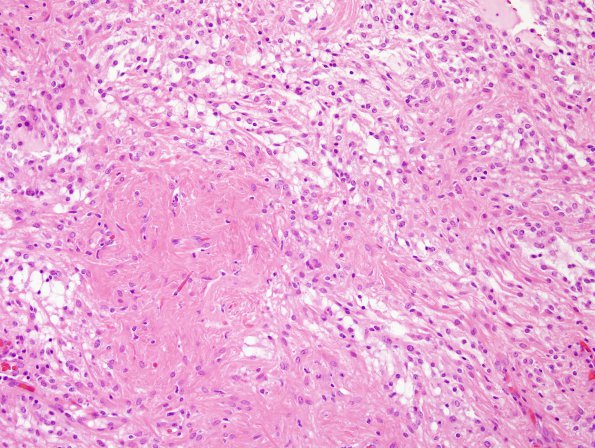 9C2 Astrocytoma, pilocytic (Case 9) H&E 3