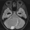 1A1 Astrocytoma, pilocytic (Case 1) FLAIR 1 - Copy - Copy