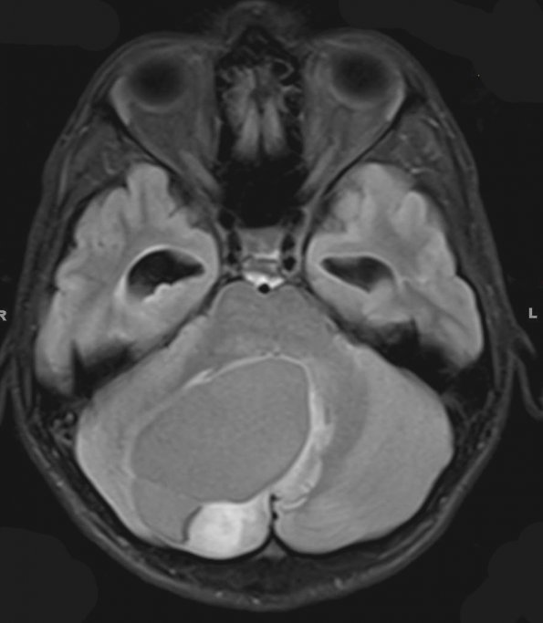 1A1 Astrocytoma, pilocytic (Case 1) FLAIR 1 - Copy - Copy