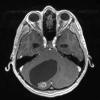 1A2 Astrocytoma, pilocytic (Case 1) T1 MPRAGE  - Copy - Copy