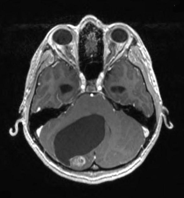 1A2 Astrocytoma, pilocytic (Case 1) T1 MPRAGE  - Copy - Copy