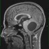 1A3 Astrocytoma, pilocytic (Case 1) T1 MPRage 2 - Copy - Copy