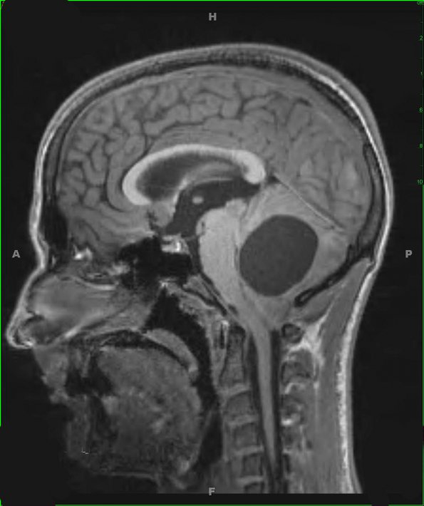 1A3 Astrocytoma, pilocytic (Case 1) T1 MPRage 2 - Copy - Copy