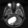 1A4 Astrocytoma, pilocytic (Case 1) T2 - Copy - Copy