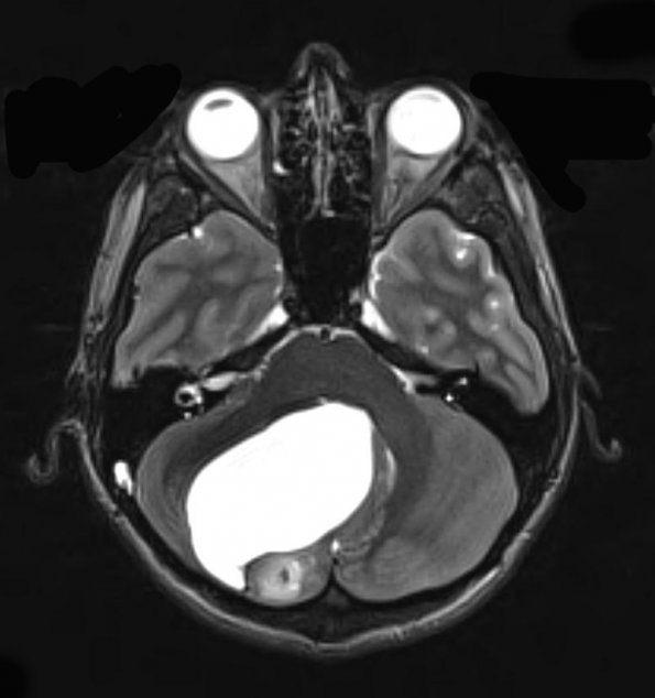 1A4 Astrocytoma, pilocytic (Case 1) T2 - Copy - Copy