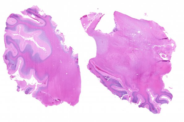 1B1 Astrocytoma, pilocytic (Case 1) H&E WM